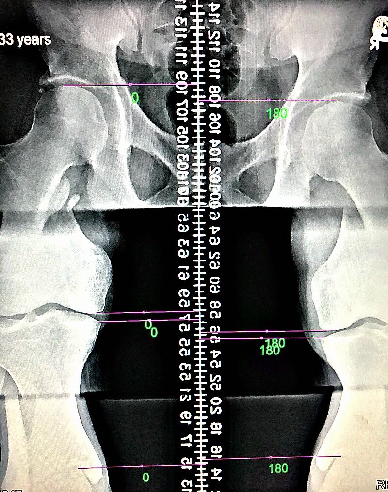 leglengthx-ray leg length x-ray